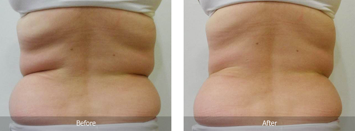 Fat freezing before after